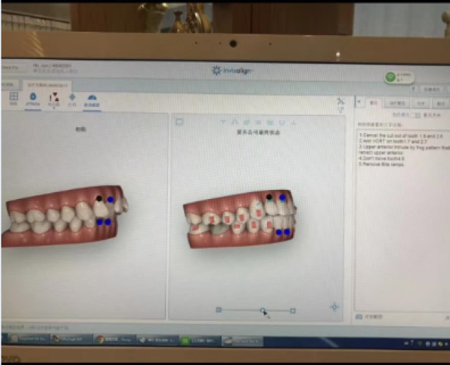 數(shù)字化種牙什么意思
