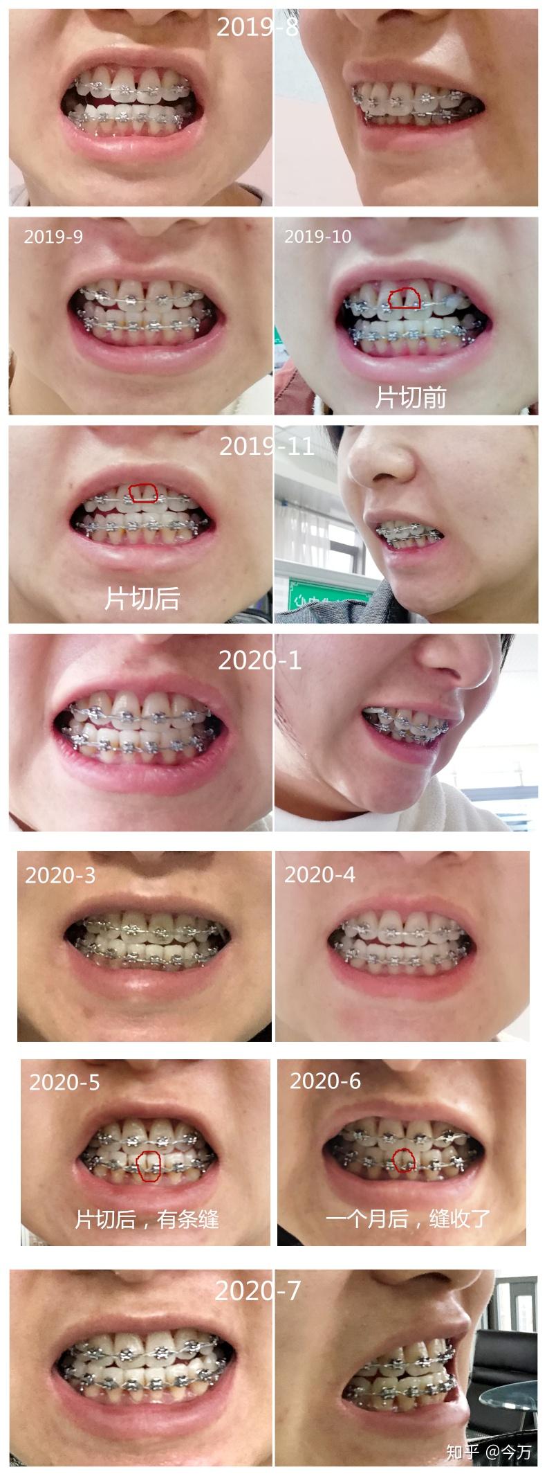 24牙齒矯正還晚嗎