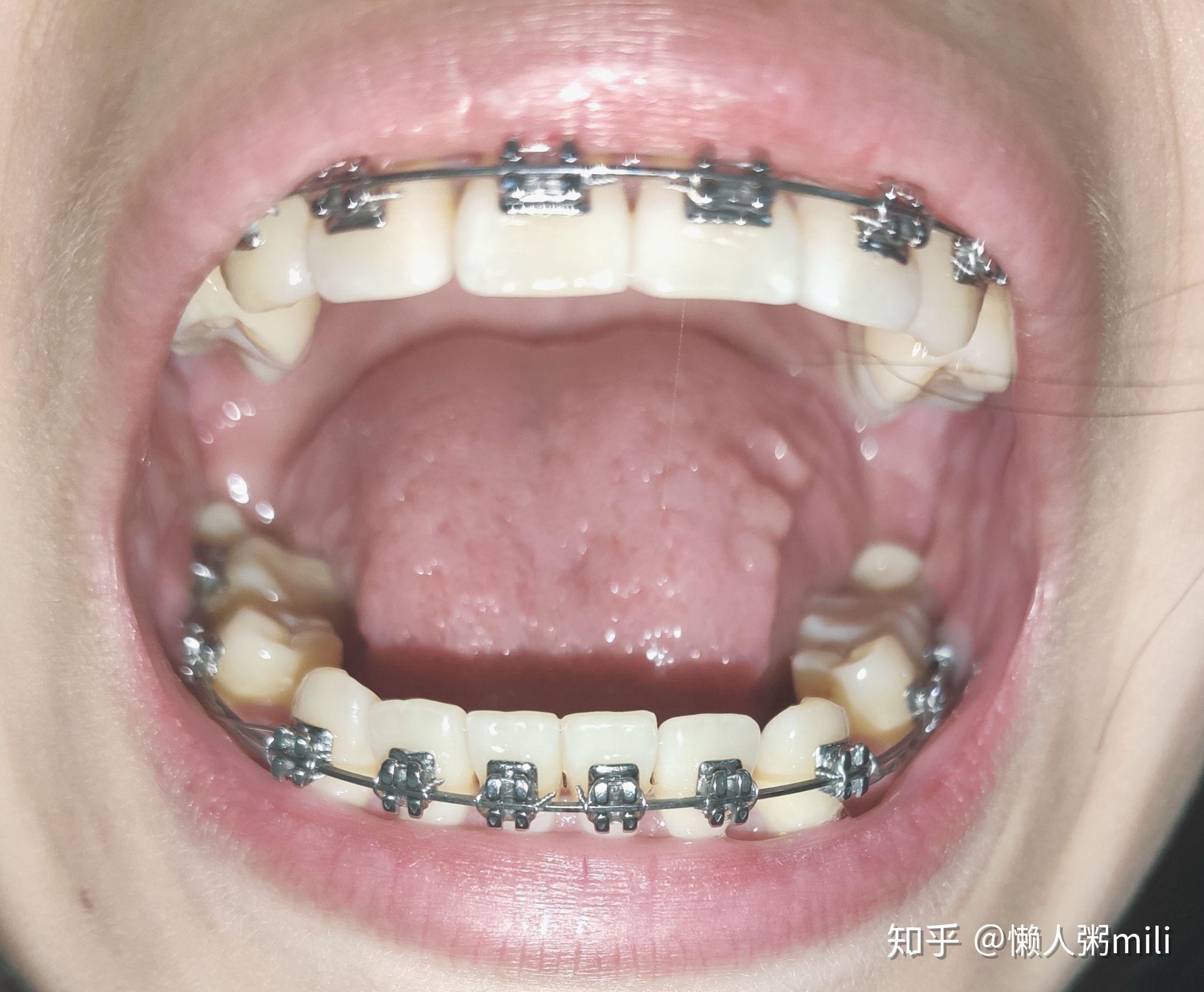 24歲可以矯正牙齒么