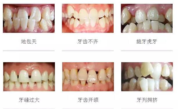 Kaiyun：【熱點(diǎn)】越早整牙越好嗎？