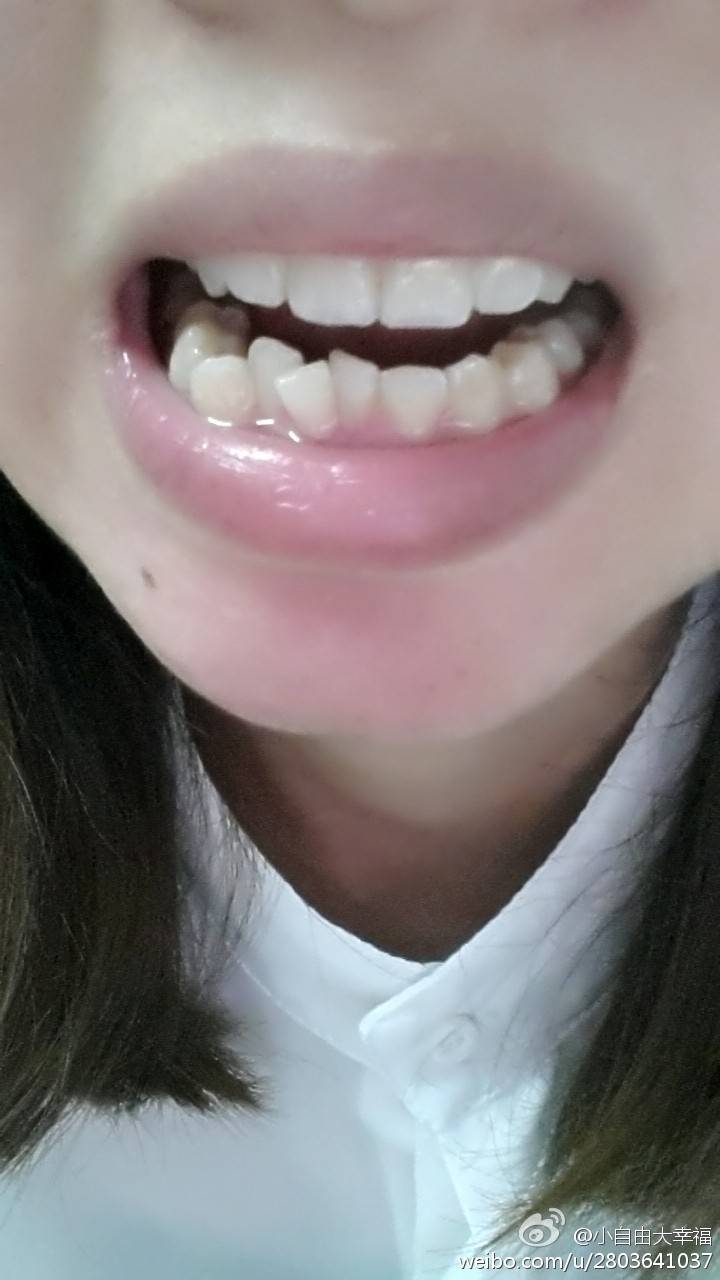 25歲做牙齒矯正來得及嗎
